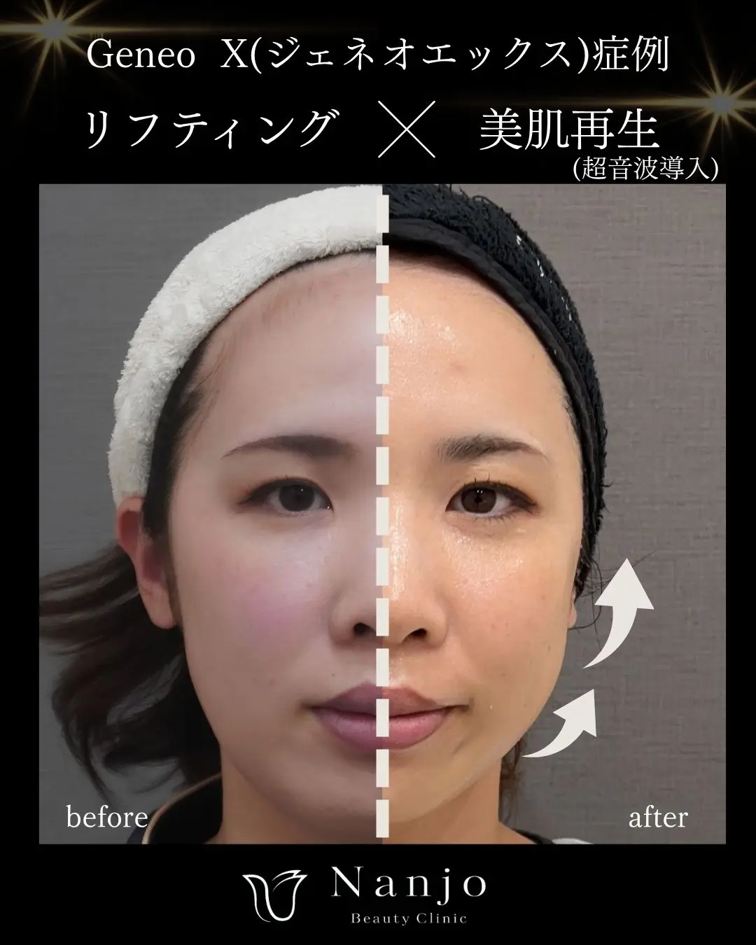 ジェネオX vs LDM｜2台の美容機器、何が違う？肌悩み別の使い分けガイド