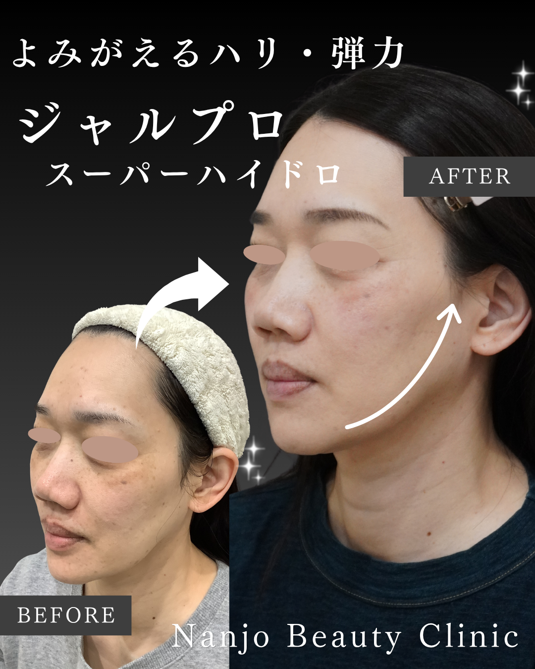 ジャルプロスーパーハイドロの症例紹介 — ハリ・リフトアップ・うるおいへのアプローチの記事画像