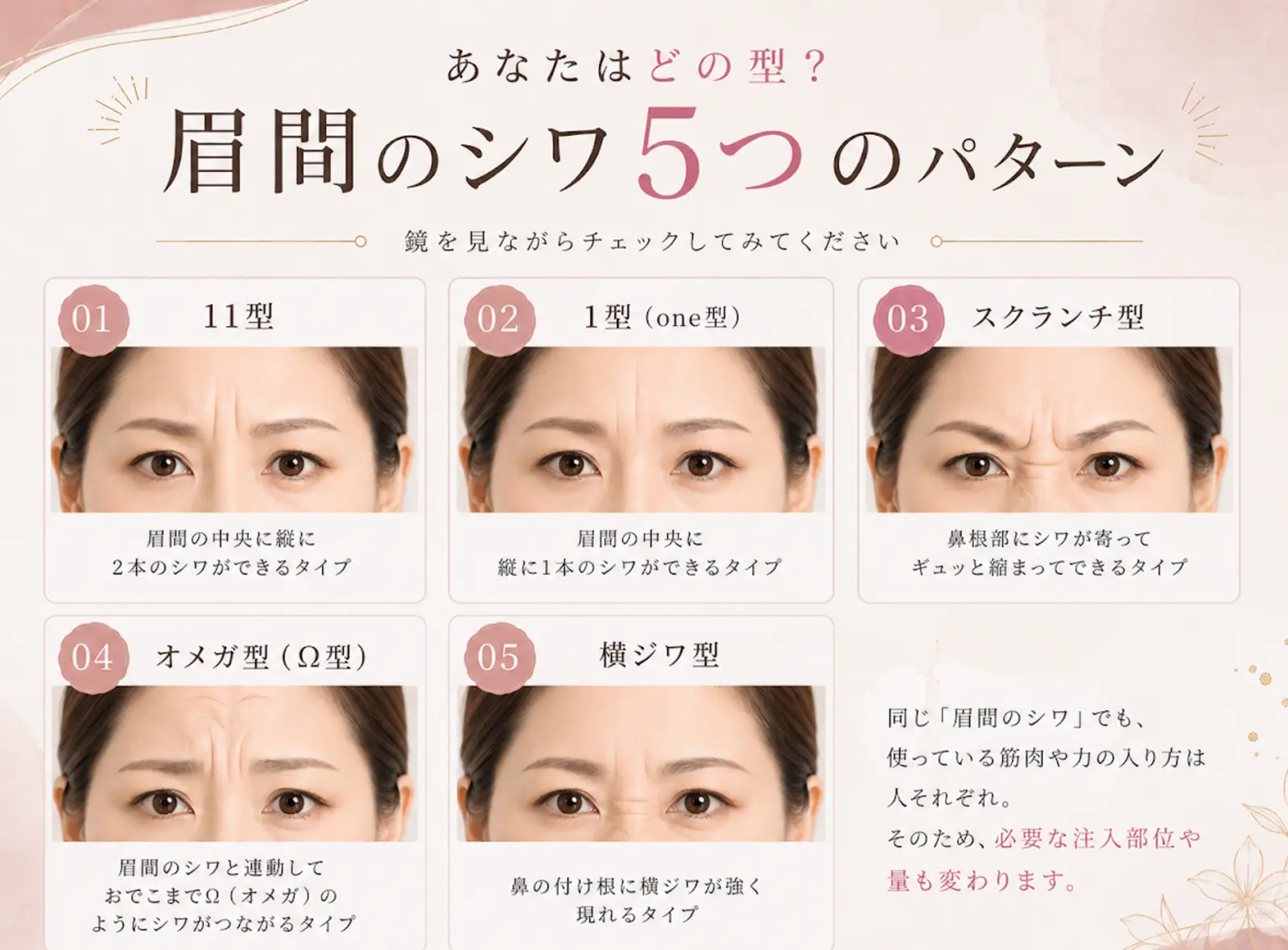眉間ボトックスの施術説明イメージ
