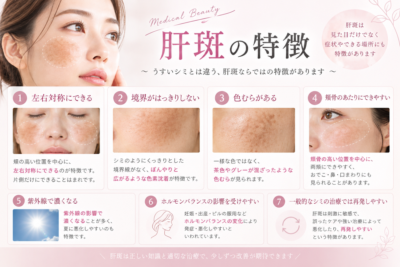 肝斑の特徴