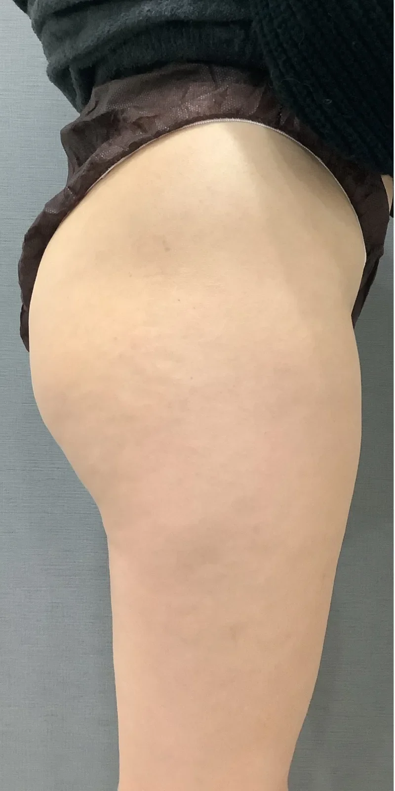 リヴァイブ ヒップ Before/After Before