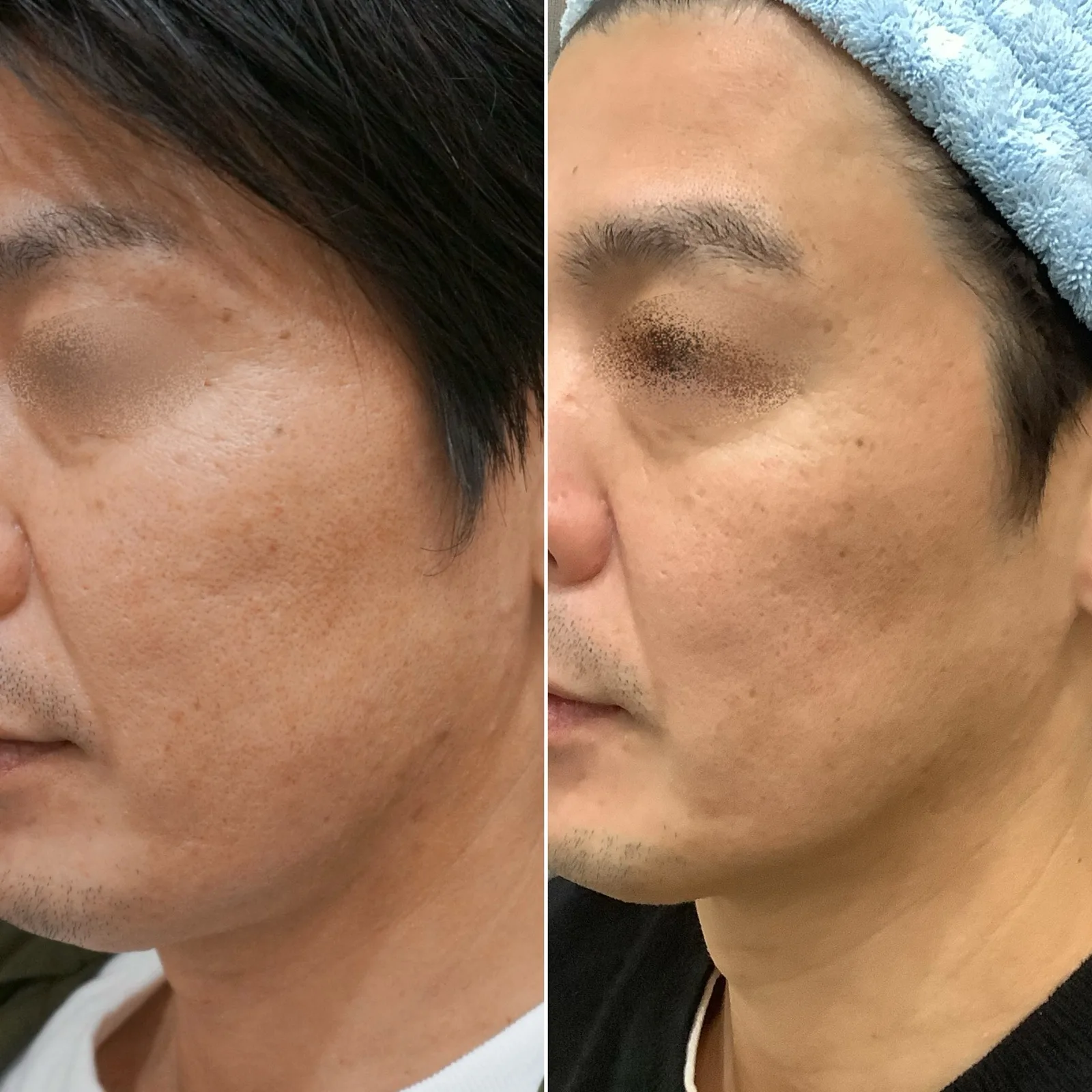 ジュベルック症例｜毛穴・ニキビ跡が改善する仕組みを医師が解説【経過写真】