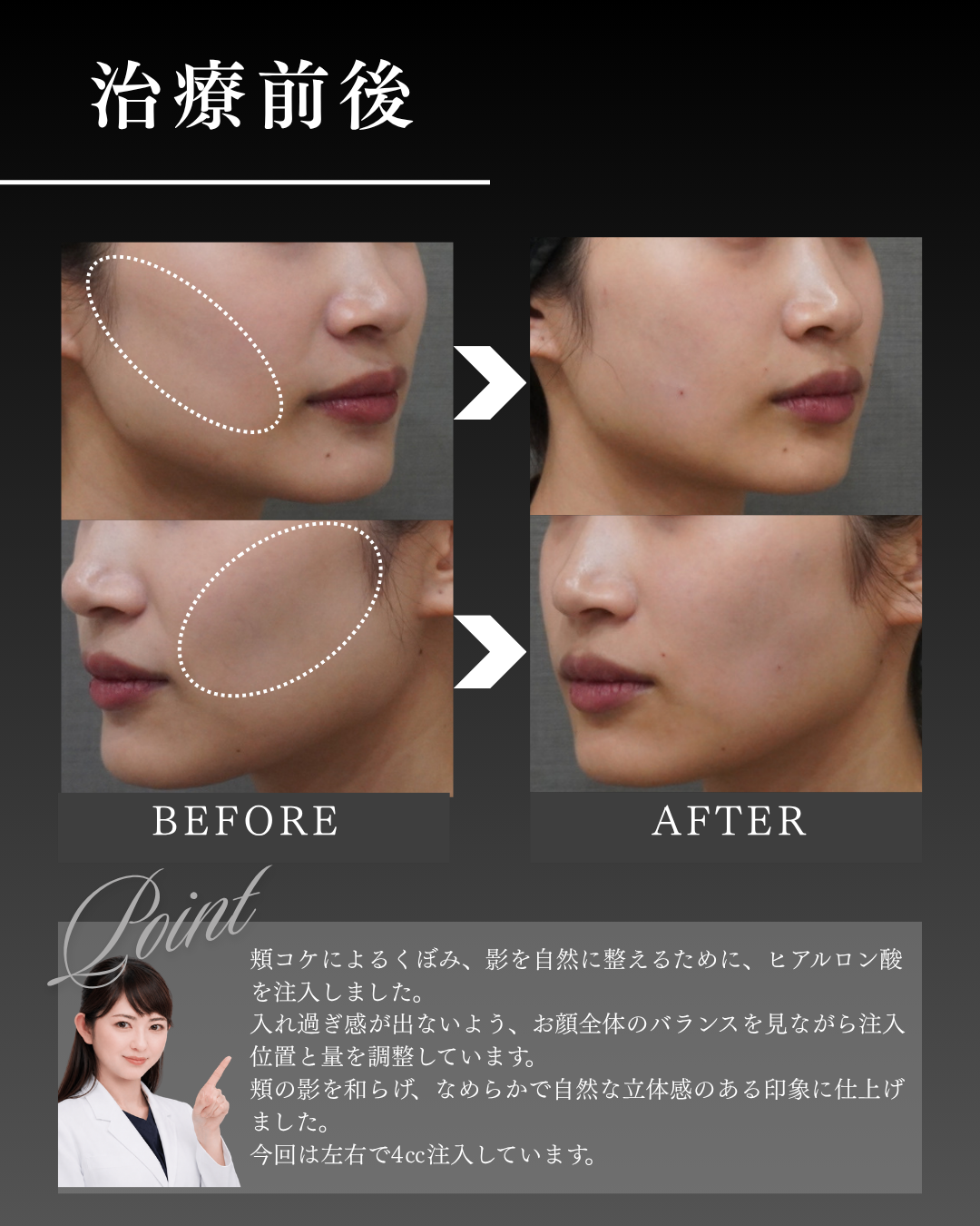 頬コケ ヒアルロン酸 症例写真（ボリューマXC 両側4cc）
