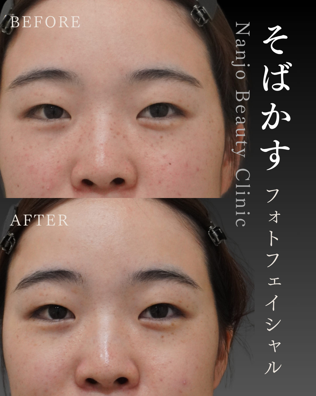 そばかすにフォトフェイシャルは効く？症例2例でわかりやすく解説｜南條ビューティークリニック