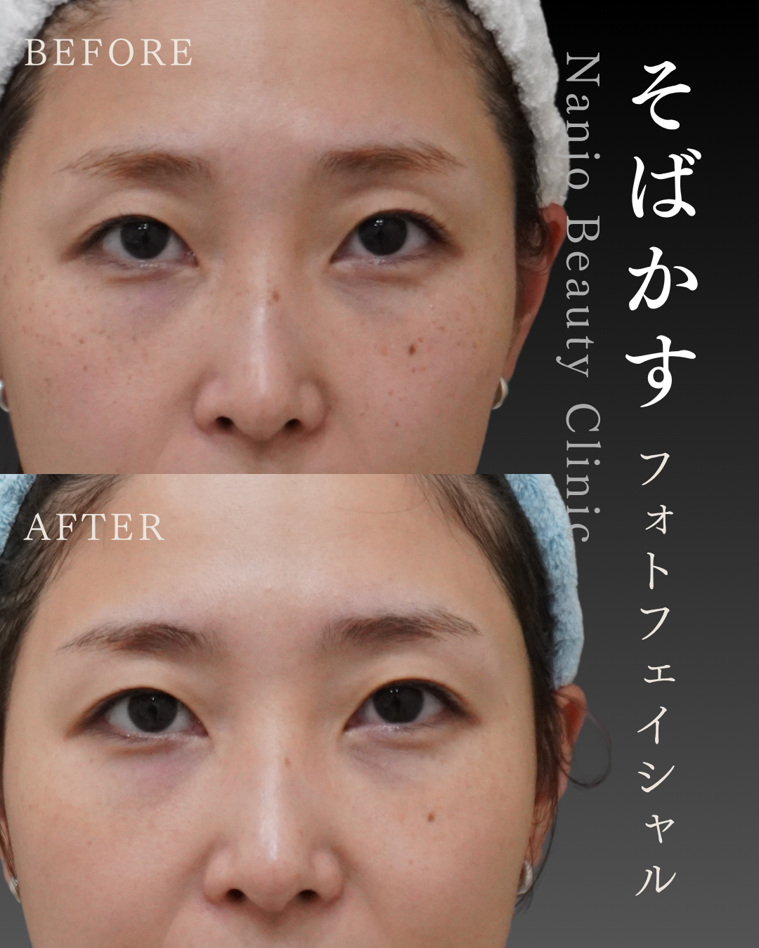 症例2 そばかす フォトフェイシャル(ステラM22)施術前後 30代女性・鼻周囲