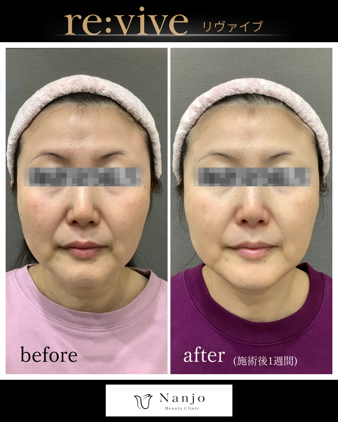 リヴァイブ フェイスライン Before/After 施術後1週間