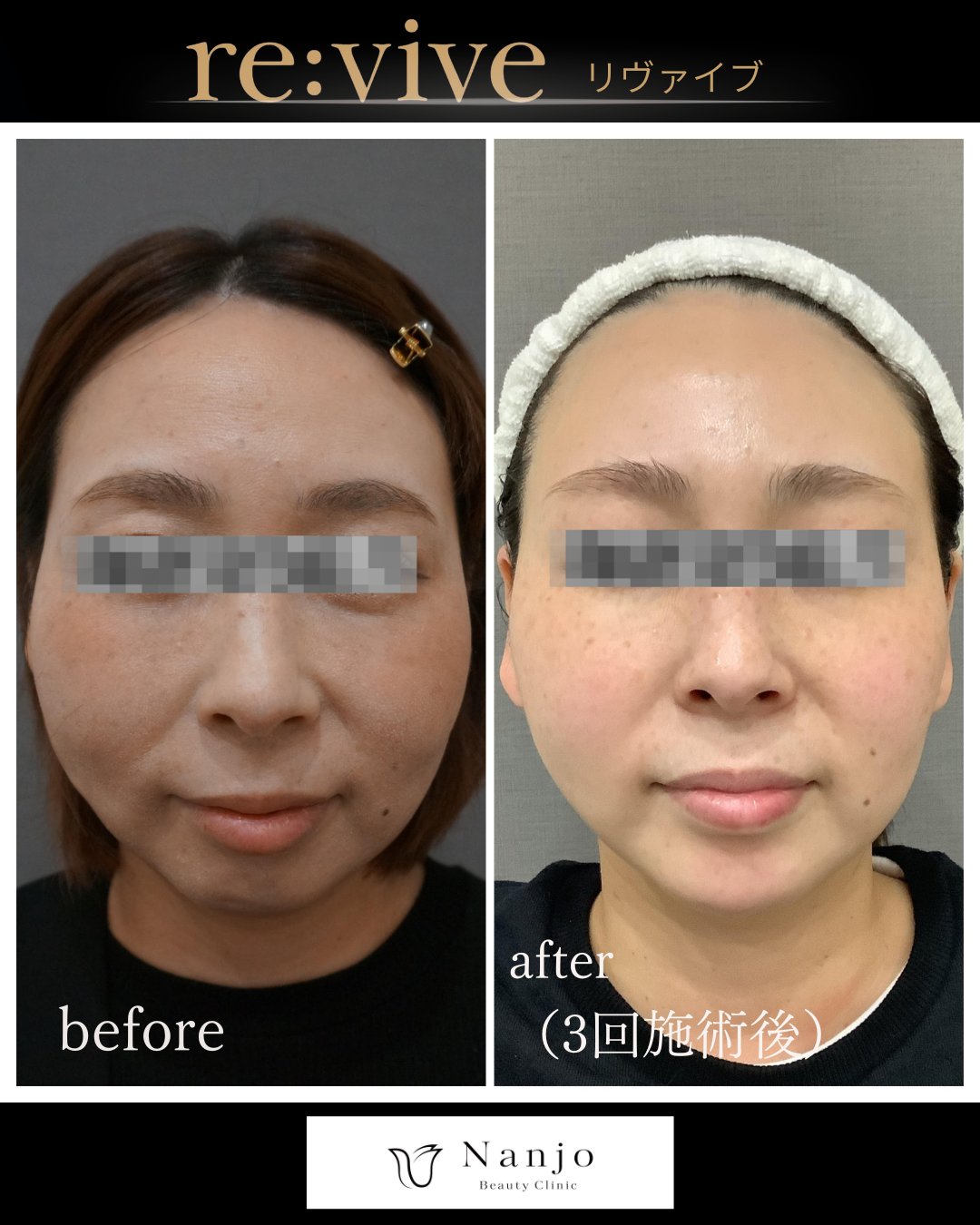 リヴァイブ フェイスライン Before/After 3回施術後