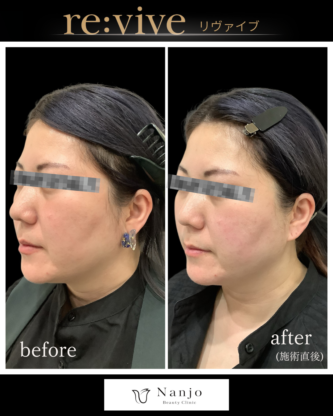 リヴァイブ フェイスライン Before/After 施術直後