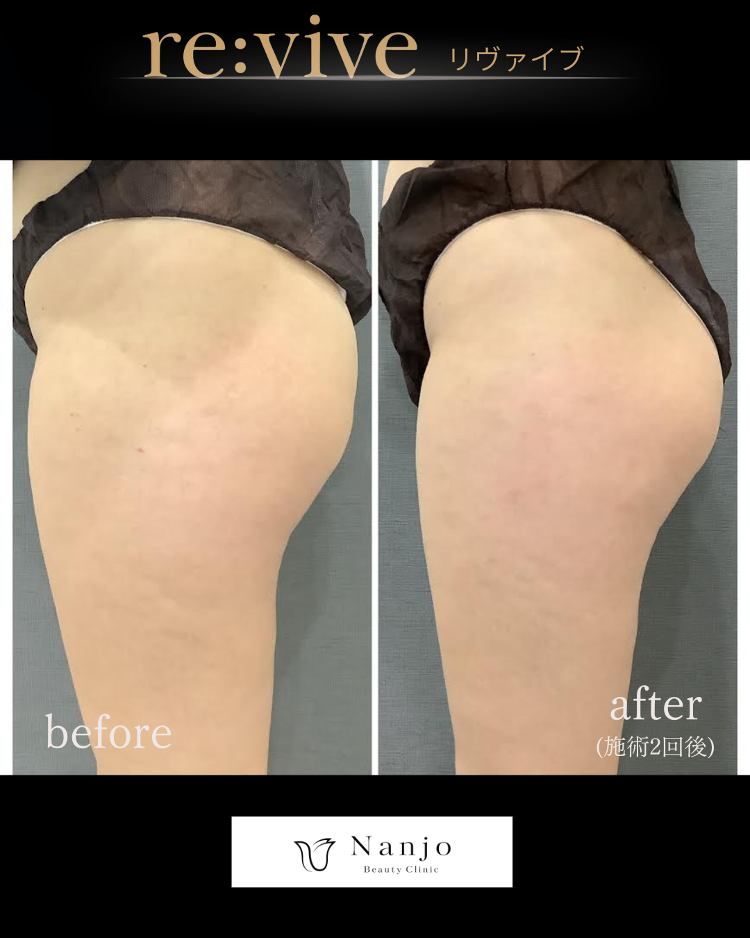 リヴァイブ ヒップライン Before/After 施術2回後