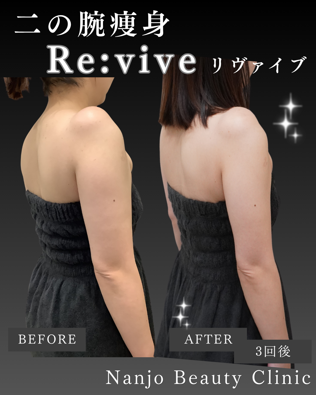 リヴァイブ（Re:vive）二の腕の症例2例 — 部分痩せの実例 | 南條ビューティークリニック